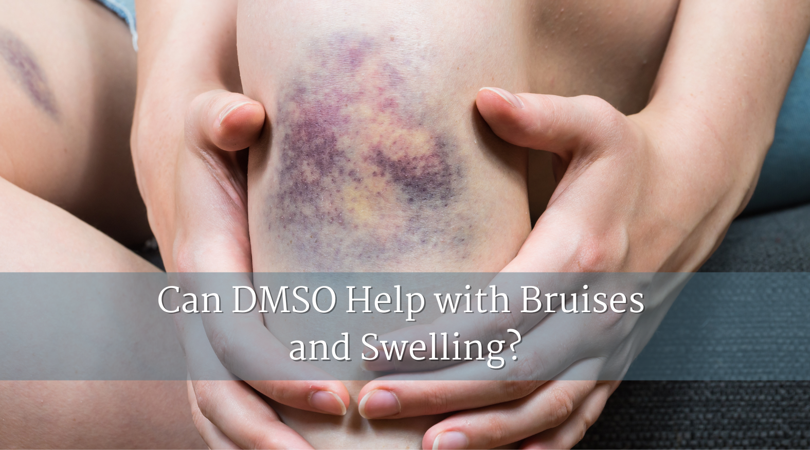 DMSO Help with Bruises and Swelling