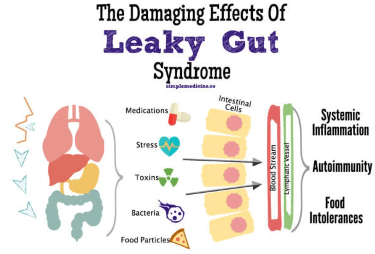 Do you have Leaky Gut Syndrome?